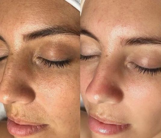 Before & After